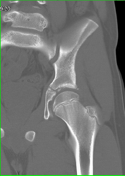 Normal Acetabulam With 2d and 3D Mapping - CTisus CT Scan