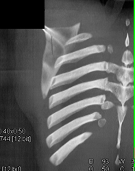 Scapular Fracture - CTisus CT Scan