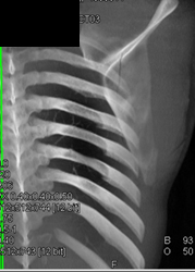 Scapular Fracture - CTisus CT Scan