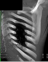 Scapular Fracture - CTisus CT Scan