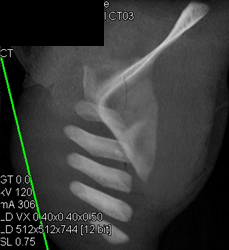 Scapular Fracture With Incidental Nodule - CTisus CT Scan