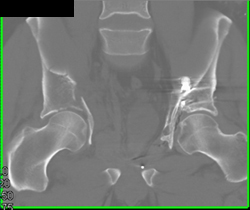 Acetabular Fracture - CTisus CT Scan