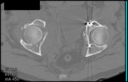 Acetabular Fracture - CTisus CT Scan