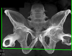 Acetabular Fracture - CTisus CT Scan