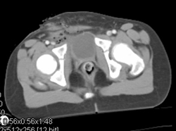 Stab Wound to Groin Without Vascular Injury - CTisus CT Scan