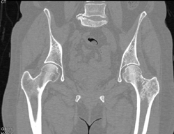 Blastic Metastases to Femur - CTisus CT Scan