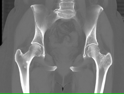 Blastic Metastases to Femu - CTisus CT Scan