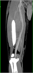 Normal Thigh CTA - CTisus CT Scan