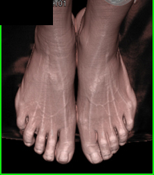 3D VRT of Feet With Different Renderings - CTisus CT Scan