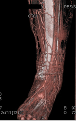 Cellulitis S/P Fracture Repair - CTisus CT Scan