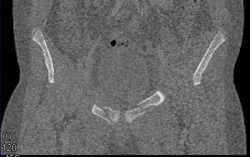 Fracture of Symphysis Bilaterally - CTisus CT Scan