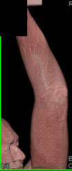 Cellulitis in 2d and 3D With Ulcer - CTisus CT Scan