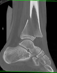 Tibial Fracture With Slip Along Epiphyseal Plate - CTisus CT Scan