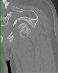 Osteogenesis Imperfecta With A Fracture - CTisus CT Scan