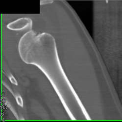 Fracture-dislocation of the Shoulder - CTisus CT Scan