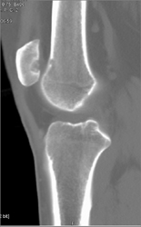 Cystic Changes of Patella - CTisus CT Scan