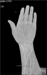 Cellulitis With Ulcer - CTisus CT Scan