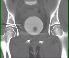 Pelvic Trauma Without Bladder Laceration - CTisus CT Scan