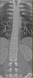 Normal T-spine - CTisus CT Scan