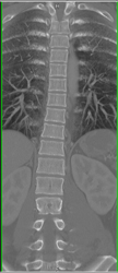 T/c Spine Off Routine 64 Slice MDCT Shows Transverse Process Fractures - CTisus CT Scan