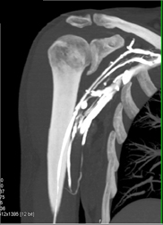 CTA of Axilla - CTisus CT Scan