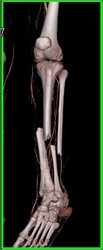 Tibial and Fibular Fractures Without Vascular Injury - CTisus CT Scan