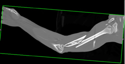 Humerus Fracture With Brachial Artery Injury - CTisus CT Scan