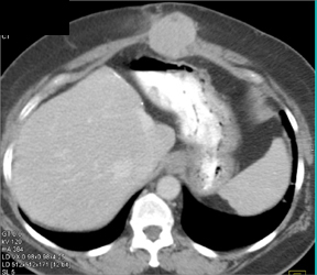 Desmoid - CTisus CT Scan