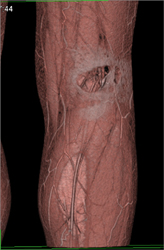 GSW to Popliteal Fossa With Soft Tissue Injury But Intact Popliteal Artery - CTisus CT Scan