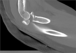 Radius Fracture and Dislocation - CTisus CT Scan