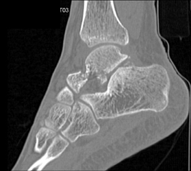 Talus Fracture - CTisus CT Scan