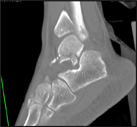 Talus Fracture - CTisus CT Scan