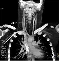 Stab Wound in Right Supraclavicular Zone Without Vascular Injury - CTisus CT Scan