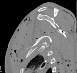 Scapular Fracture and Rib Fractures Due to GSW - CTisus CT Scan