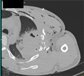 Lung Contusion and Rib Fractures - CTisus CT Scan