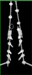 3D of Bone and Rods - CTisus CT Scan