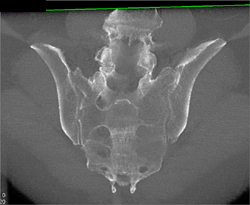 Myeloma - CTisus CT Scan