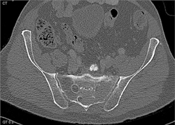 Myeloma - CTisus CT Scan