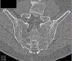 Myeloma - CTisus CT Scan