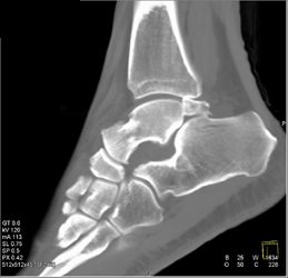 Talus Fracture - CTisus CT Scan