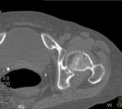 Femur Fracture - CTisus CT Scan