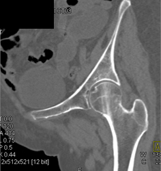 Femur Fracture - CTisus CT Scan