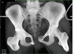 Symphysis Fractures With Diastasis and Pelvic Ring Injury - CTisus CT Scan