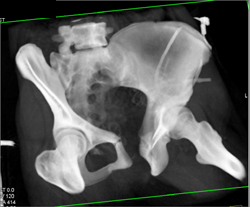 Complex Series of Pelvic Fractures and Diastasis - CTisus CT Scan