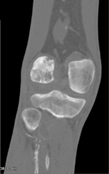 Avascular Necrosis (AVN) of Femur - CTisus CT Scan