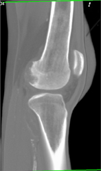 Cystic Lesions Femur Possibly Due to Old Trauma - CTisus CT Scan