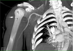 Normal Brachial Artery - CTisus CT Scan