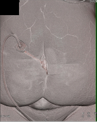 Drain Into Abscess Through Muscle - CTisus CT Scan