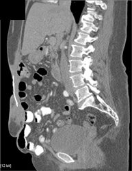 Mess?? Abdominal Wall - CTisus CT Scan