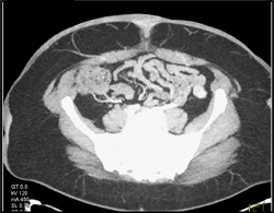 Post-op Abdominal Wall - CTisus CT Scan